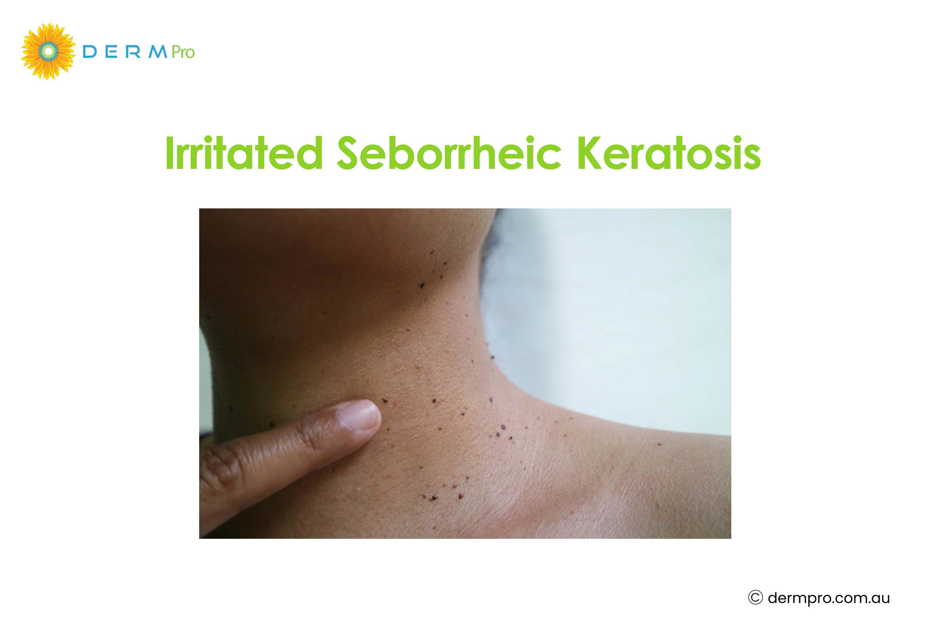 Irritated Seborrheic Keratosis